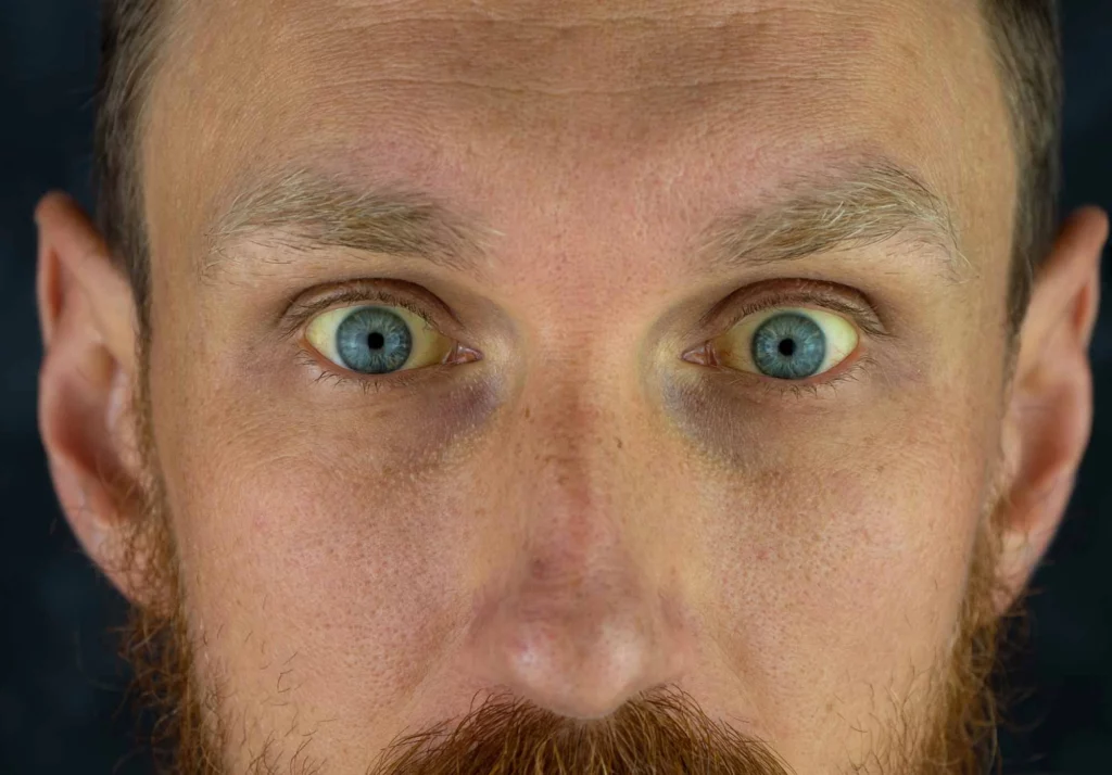 Можно ли работать с синдромом Жильбера на тяжелом производстве